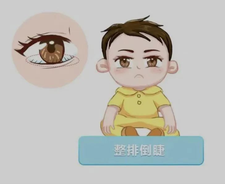 眼睫毛倒着长戳眼睛做手术多少钱,眼睫毛倒着长戳眼睛民间说法