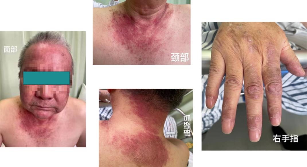 全身肌肉酸痛无力发软是甲流吗,前上纵隔见团块状软组织密度影