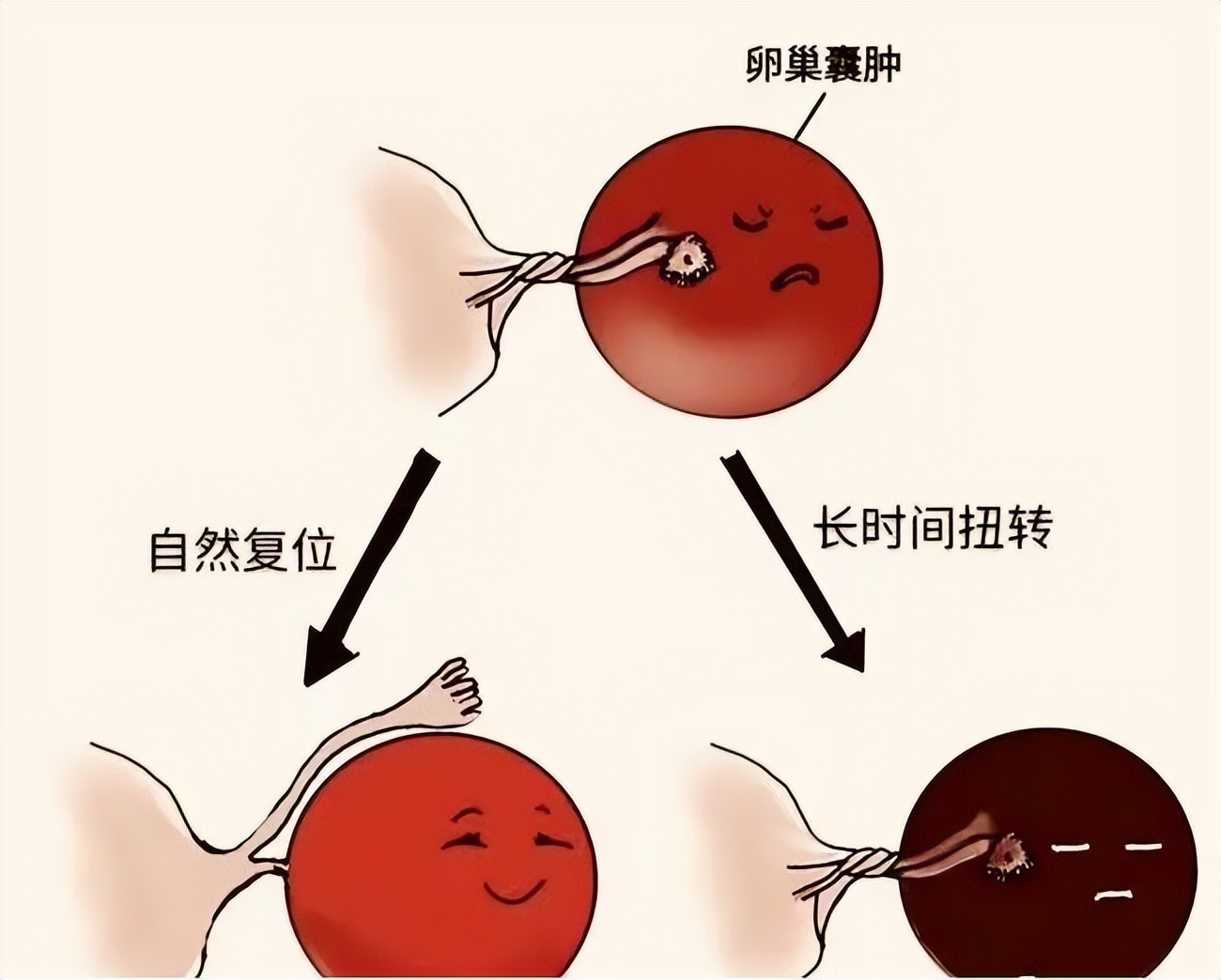 超声显示子宫肌瘤卵巢囊肿,显微镜下的卵巢囊肿