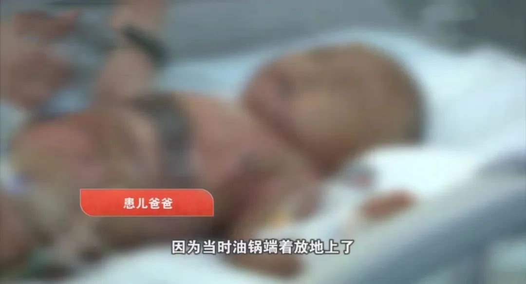 悲痛！女童全身60%烧伤，170万仅能保命！烧伤后到底该怎么做