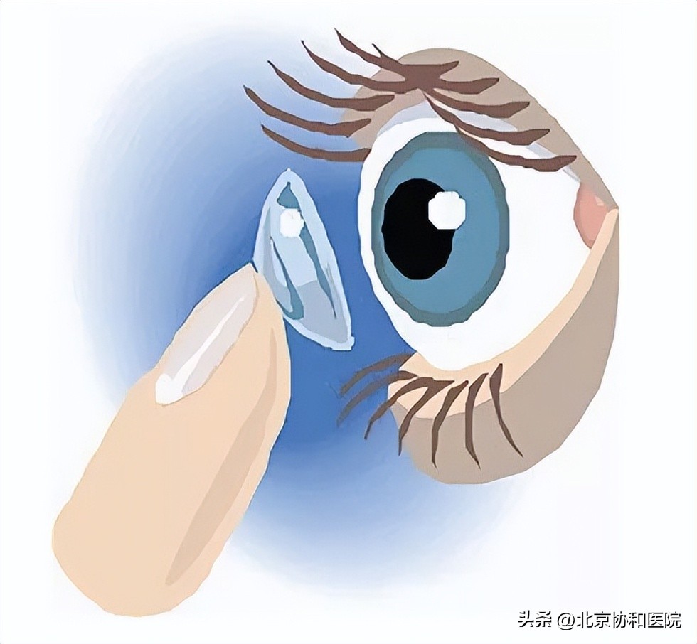 ok镜是怎么控制近视的,ok镜真的能治好初期近视吗