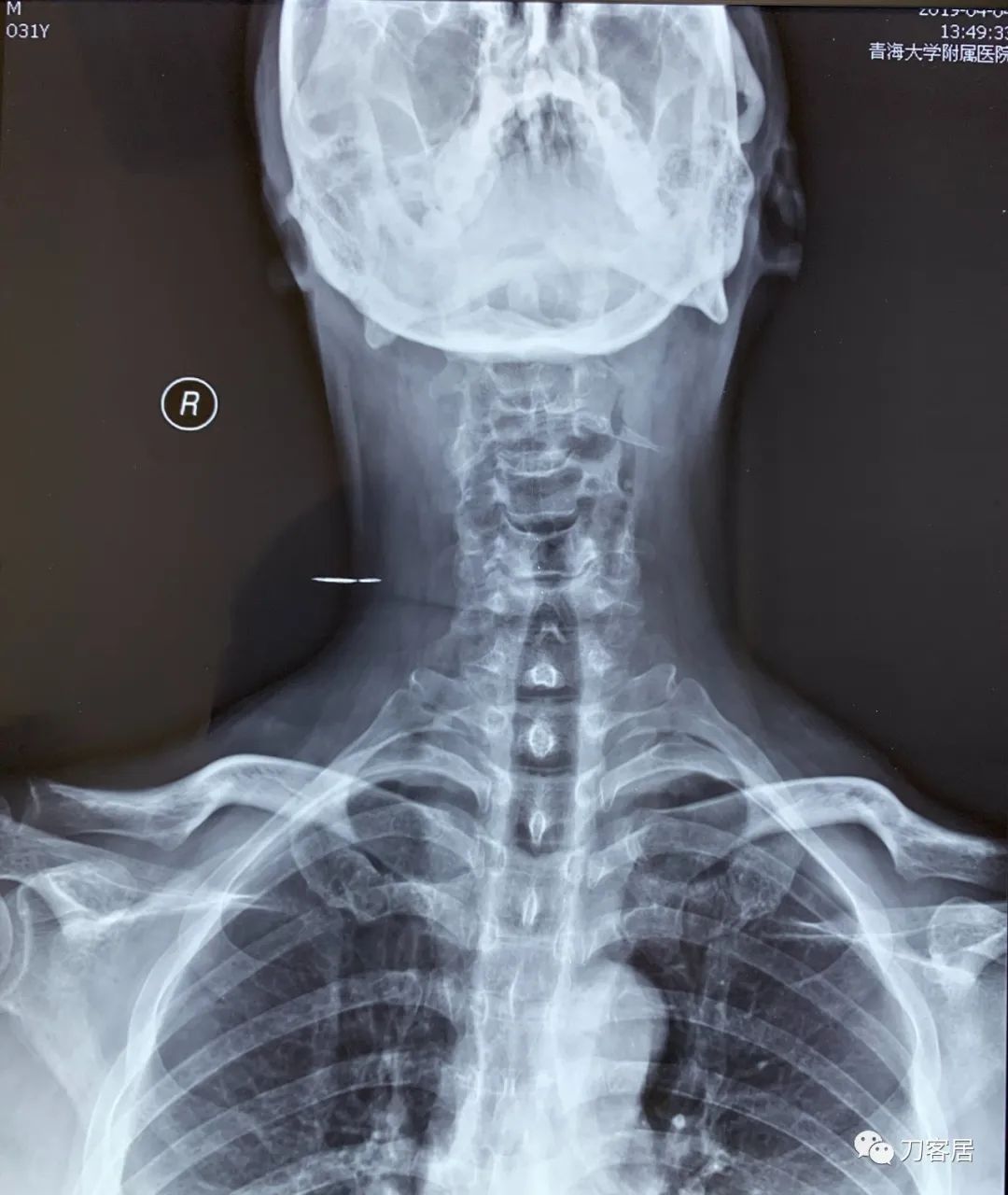 右手拇指间歇性麻木，颈椎病，颈椎失稳的保守治疗