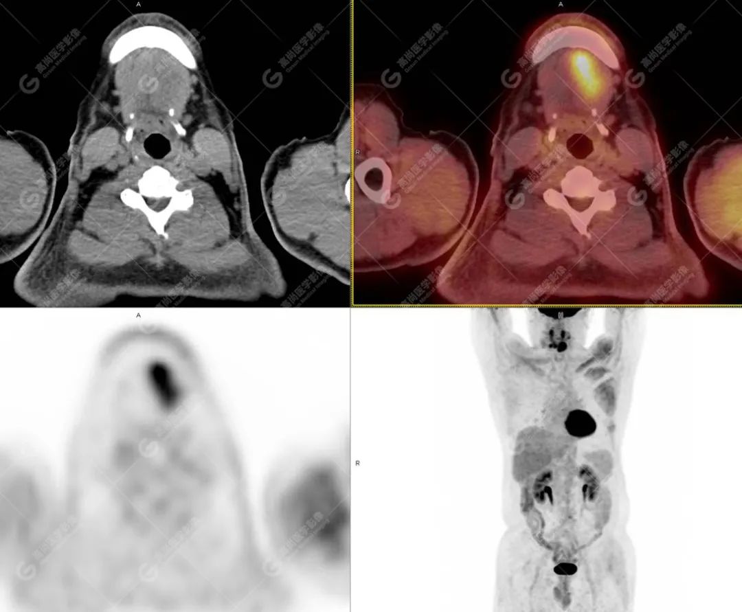 肺部结节确诊是癌如何治疗,肺结节疑似早期恶性肿瘤