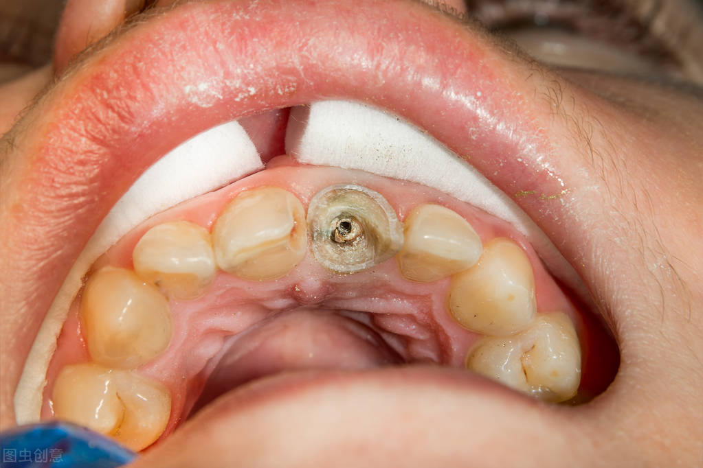牙齿隐裂牙根完好可以保住么,牙齿蛀虫后只剩牙根要不要拔掉