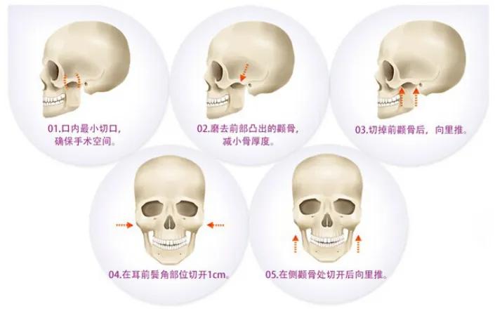 做下颌角有无年龄限制,四十岁还适合做颧骨手术吗