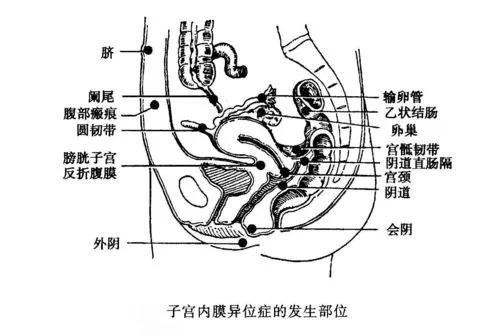 痛经、*交性**痛、急性腹痛、慢性盆腔疼痛及大便痛等，原因？应对？