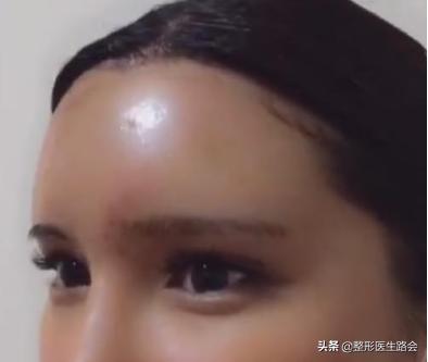 自体脂肪丰额头的危险,自体脂肪和膨体