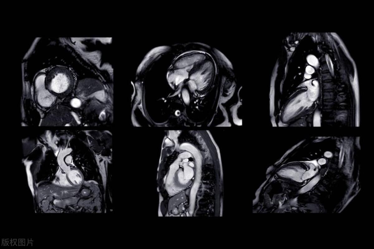 冠心病能乱停药吗?提醒:给您讲讲这5种常备药,作用是什么