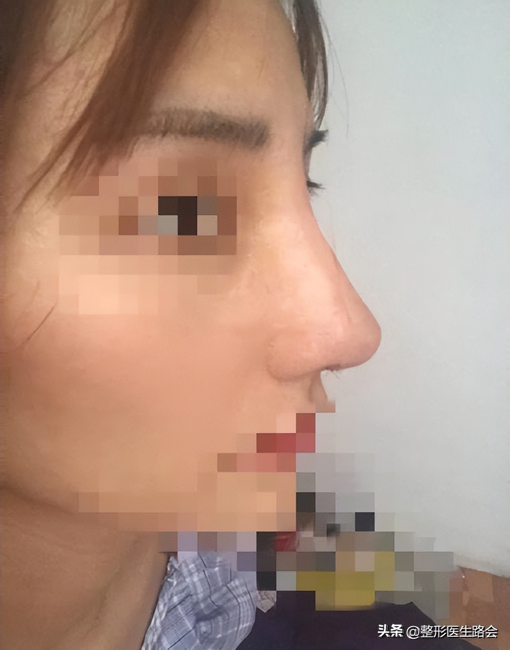 千万别做硅胶隆鼻,千万不要做玻尿酸隆鼻