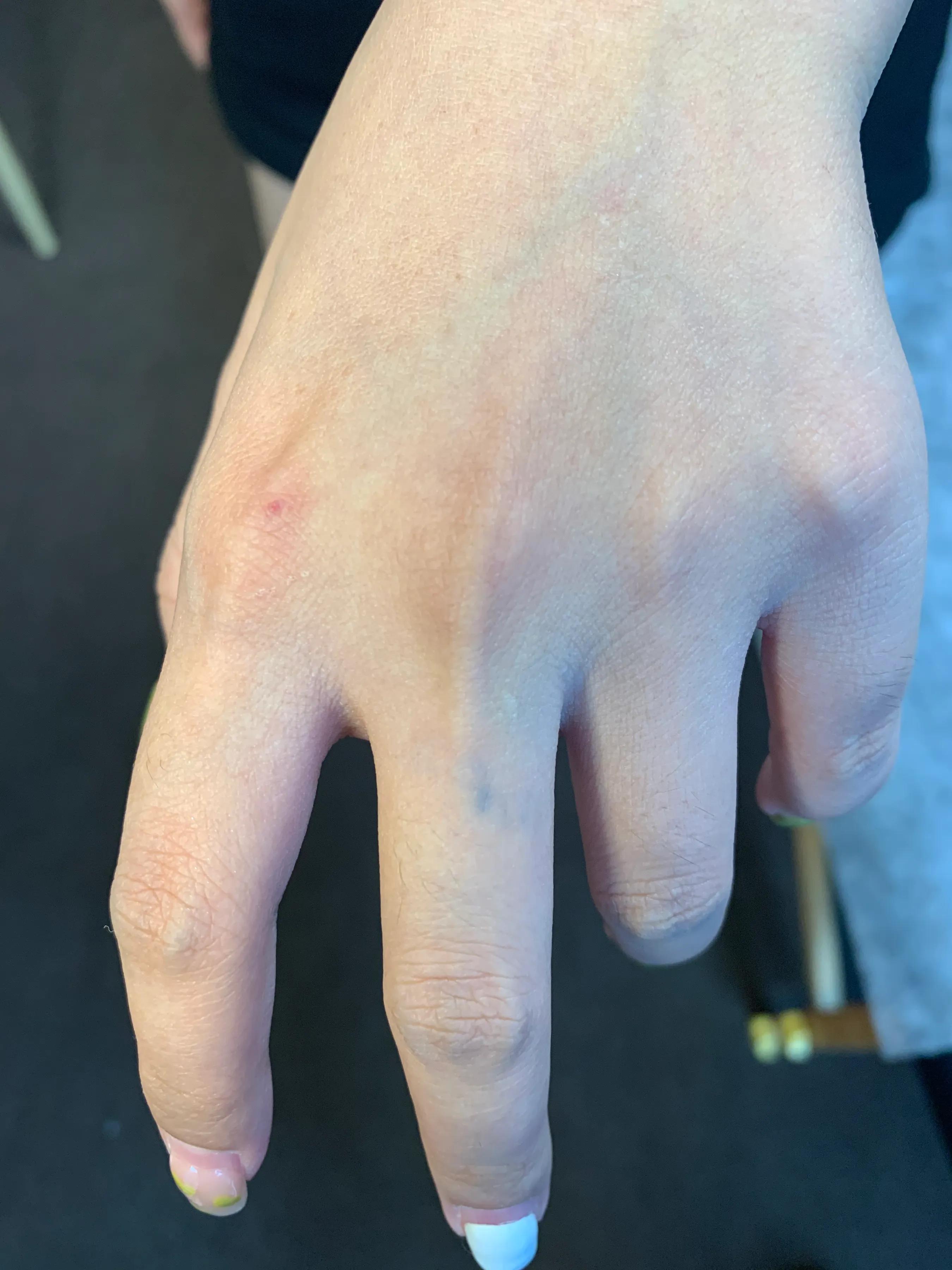 广州一次性洗纹身技术,深圳洗纹身不留疤哪家好