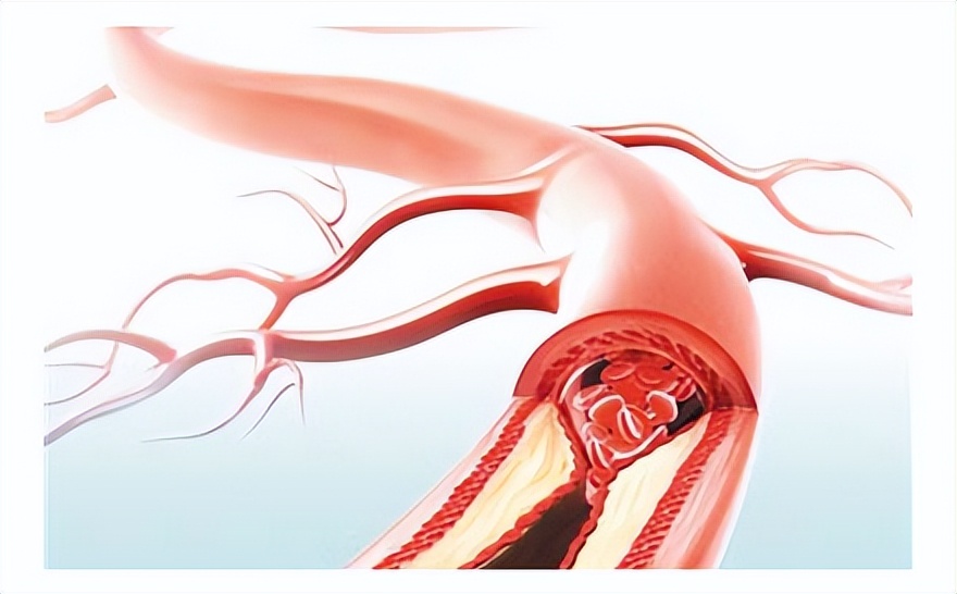 血管外科刁永鹏：动脉硬化患者应怎样锻炼？3种方式你适合哪种