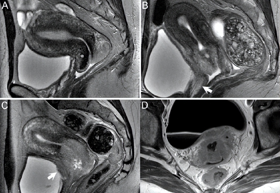 宫颈癌检查能查出子宫内膜癌吗,盆腔磁共振能看出子宫内膜癌吗