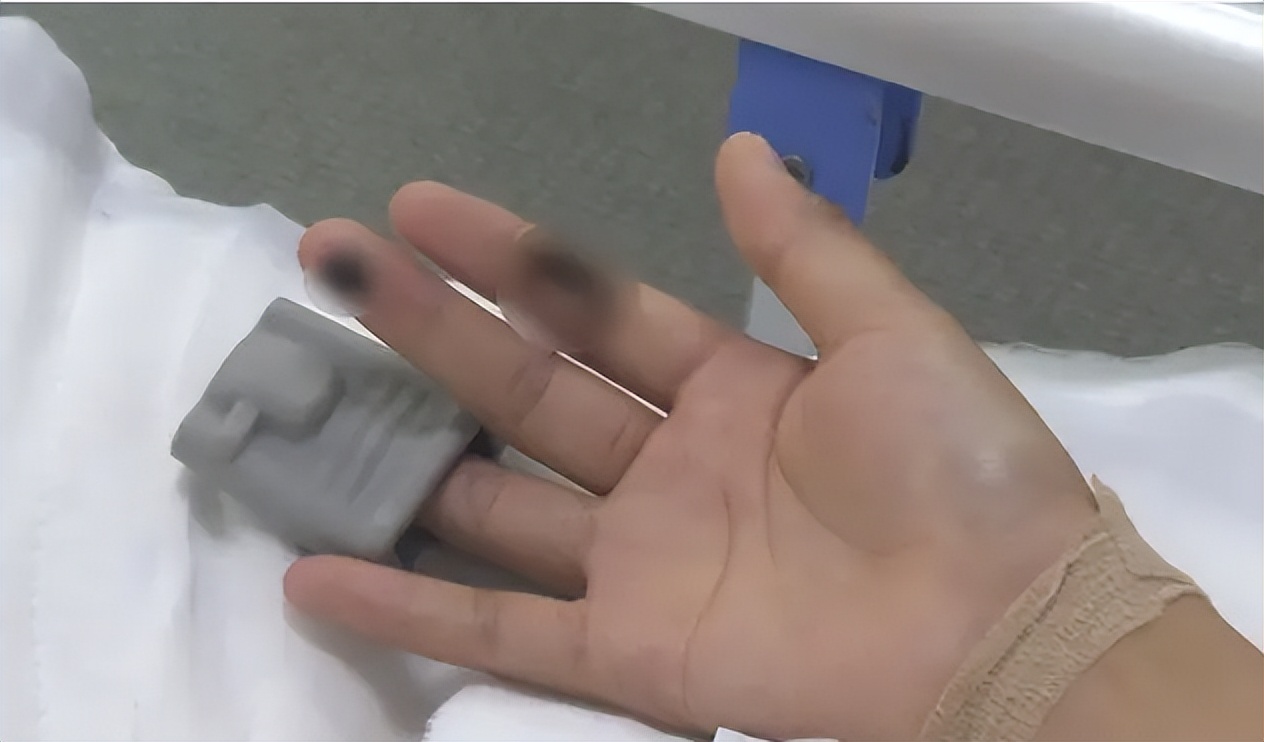 苹果充电被电到人要截肢,买iphone遭电击