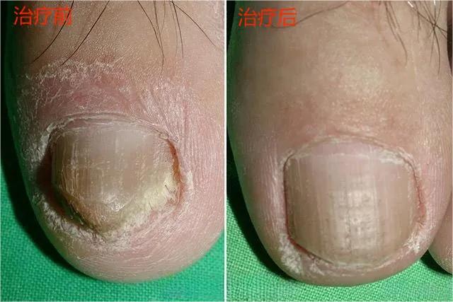 甲癣不严重怎么治疗,甲易生治疗灰指甲吗