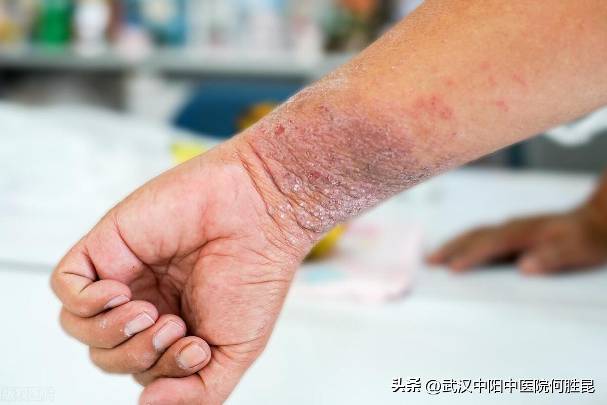 小腿皮肤和腰部皮肤瘙痒越抓越痒,腿上背上痒得很越抓越痒怎么办