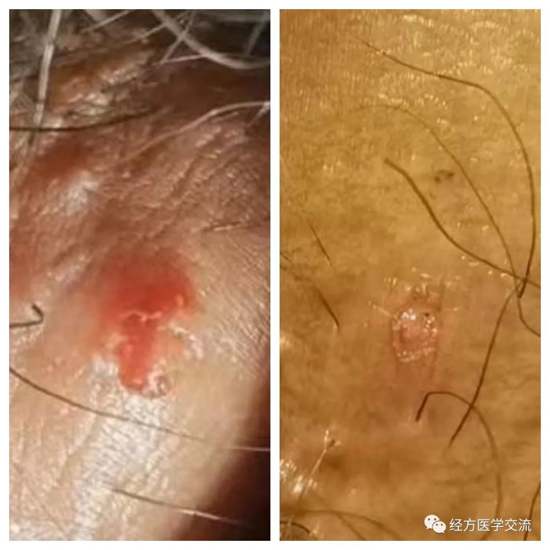 尖锐性湿疣中医辨证治疗,中医治疗尖锐性湿疣的偏方