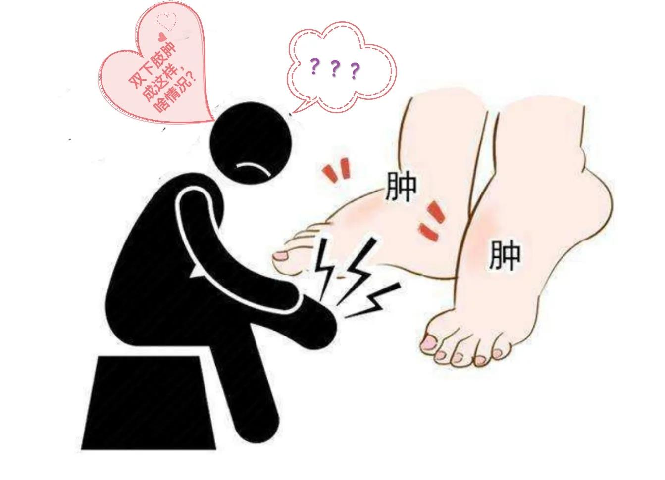 双下肢水肿心源性,心衰双下肢水肿