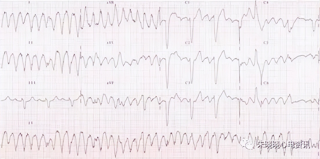 心电图机干扰信号过大的原因,心电伪差一般是指哪些干扰