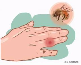 蜂蜇伤莫慌张小常识,被蜂蜇伤会出现什么症状