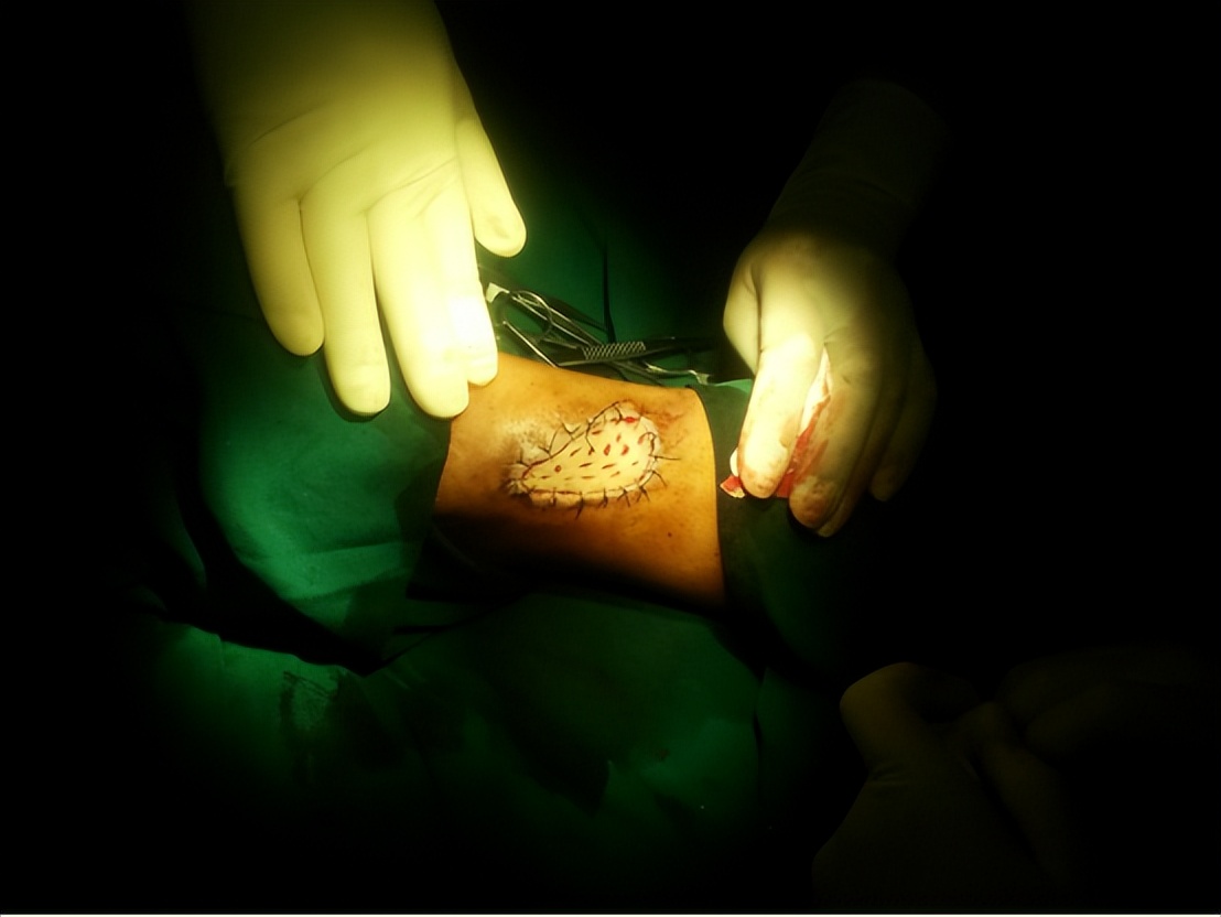 烧伤患者创面处理,烧伤创面处理的原则主要是