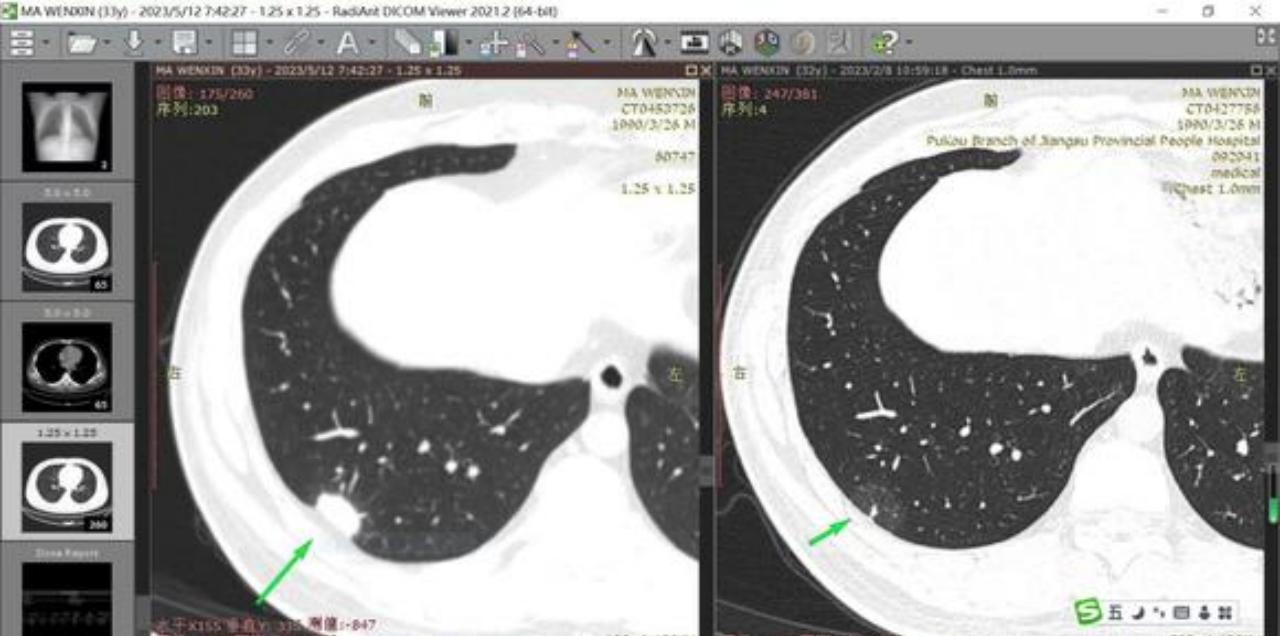 23mm的结节,23mm实性肺结节