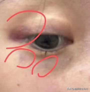 三甲医院注射玻尿酸都没事吧,三甲医院的医生注射玻尿酸专业吗