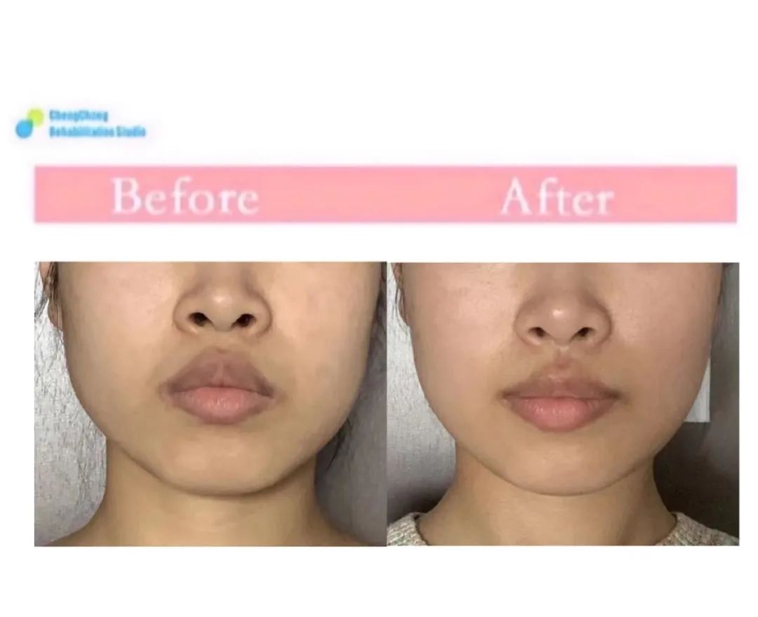 下颌骨歪斜引起脸歪图片,下颌歪斜导致大小脸怎么办