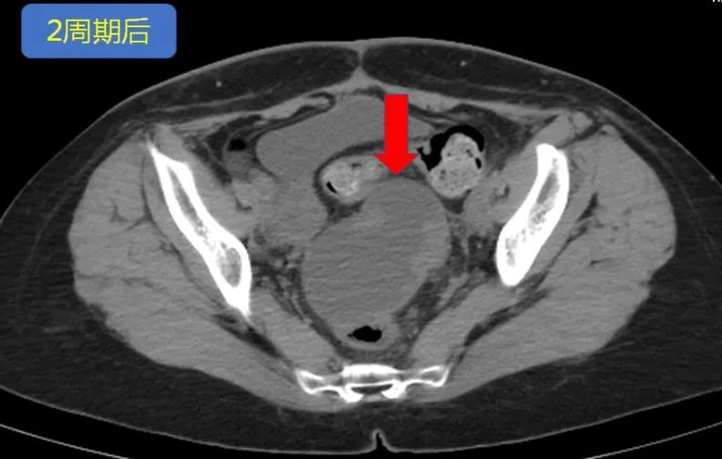 卵巢癌出现肠梗阻怎么治疗,卵巢癌晚期肠梗阻怎么治疗