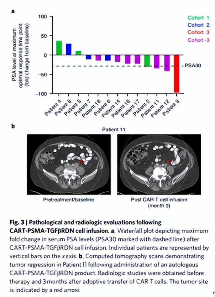 免疫细胞实体瘤成功案例,全球免疫细胞治疗实体瘤发展现状