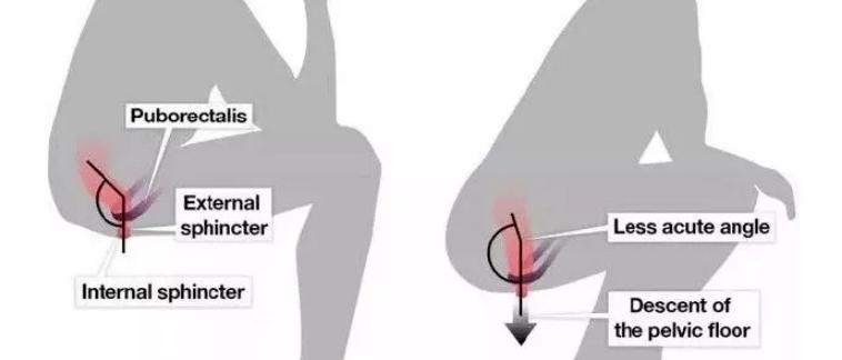 拉屎太用力有什么后果,拉屎便秘快速解决小妙招