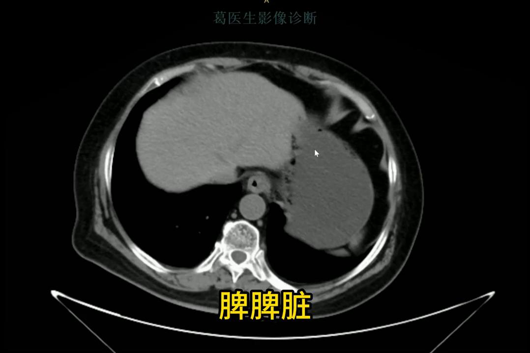 腹部ct影像解剖图谱,腹部ct阑尾影像