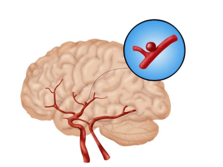 大脑萎缩严重时会产生什么后果,大脑在慢慢的萎缩是什么症状