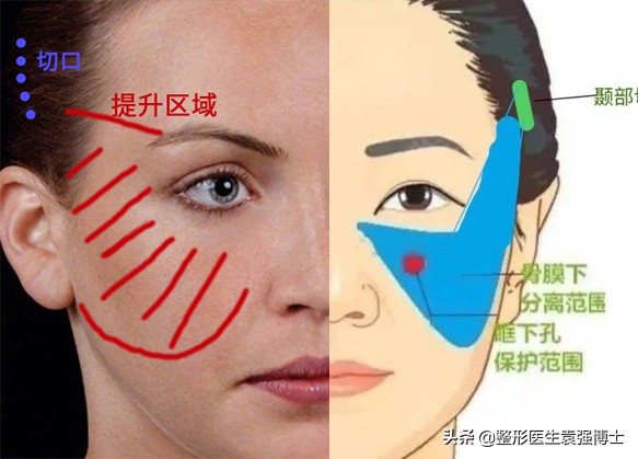 拉皮变美逆龄抗衰,拉皮逆龄抗衰