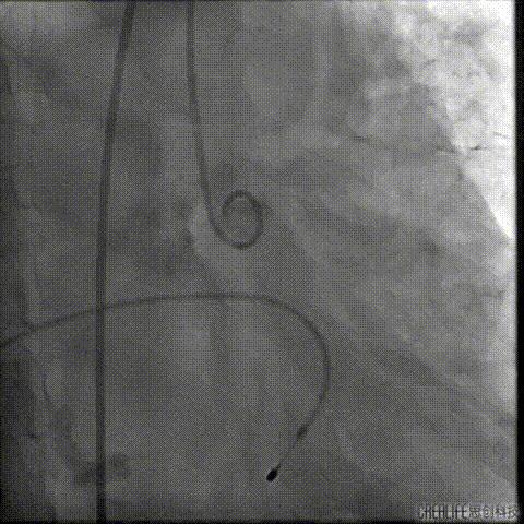 病例回顾与分享,腹膜后血肿介入治疗