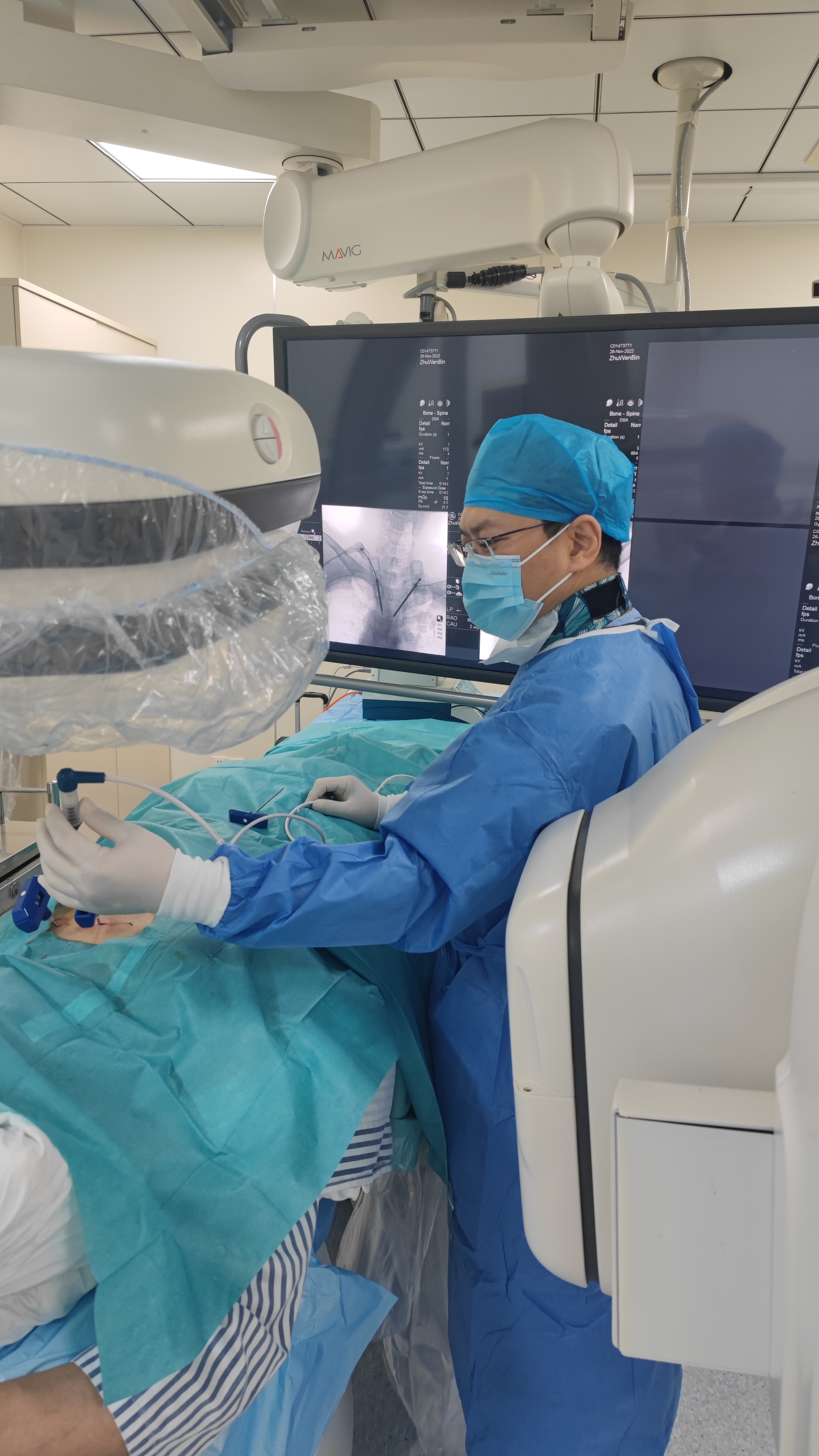 病例Ⅴ：RF+PVP联合治疗高位胸椎溶骨性转移瘤及压缩骨折