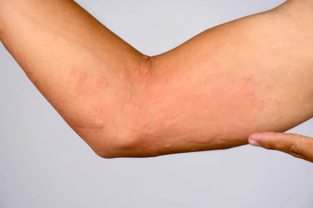 进入冬季皮肤瘙痒是什么原因,入春脸特别痒