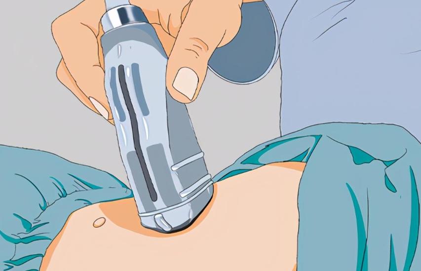 人流这种小手术都用了全麻，而剖宫产却用半麻？这是怎么回事呢？