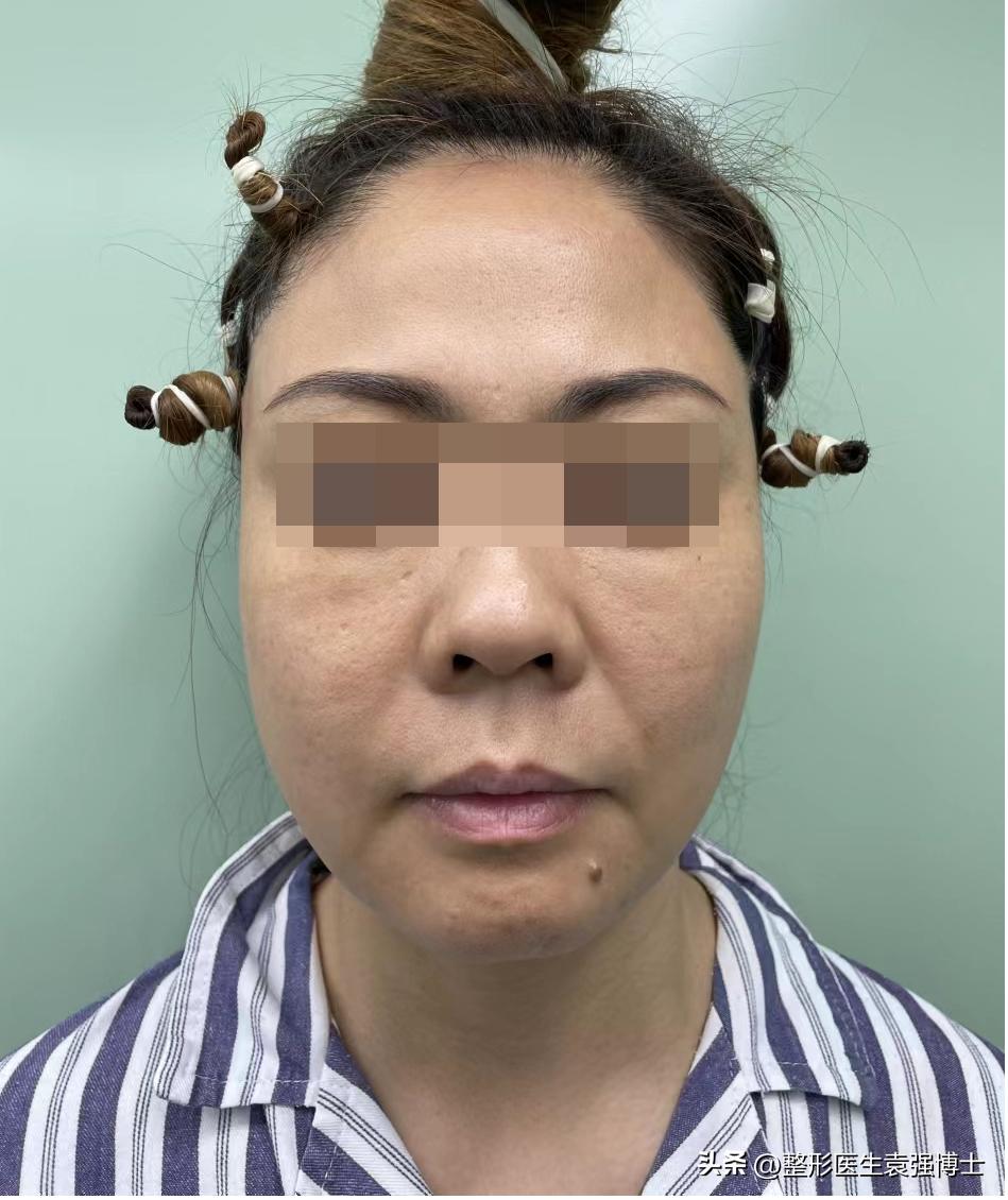 大拉皮多久可以修复大小脸,拉皮改善面部松弛