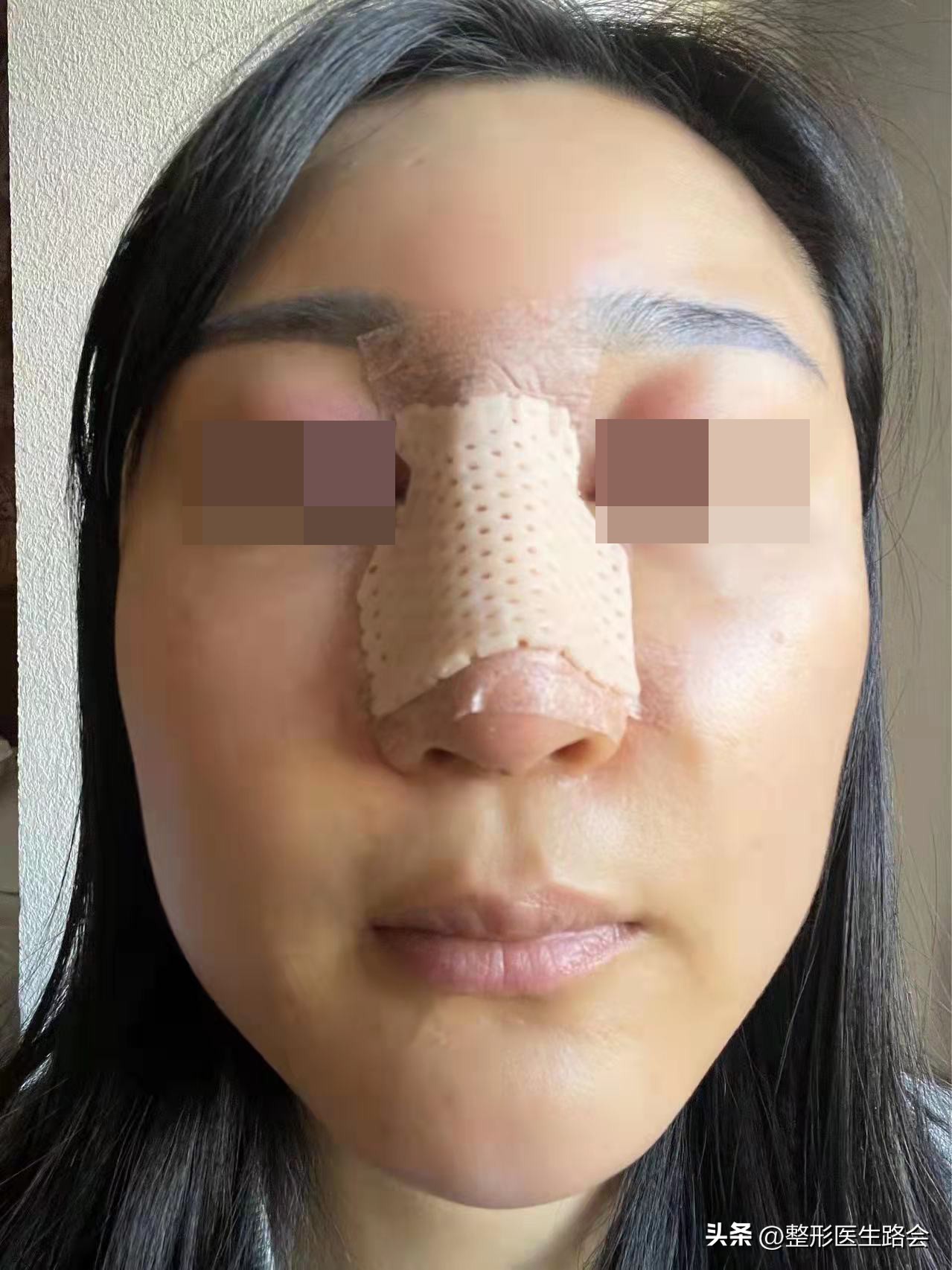 做鼻基底填充消除法令纹有风险吗,鼻基底填充能消除法令纹吗