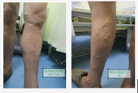 静脉曲张科普创意视频,精索静脉曲张科普动画视频