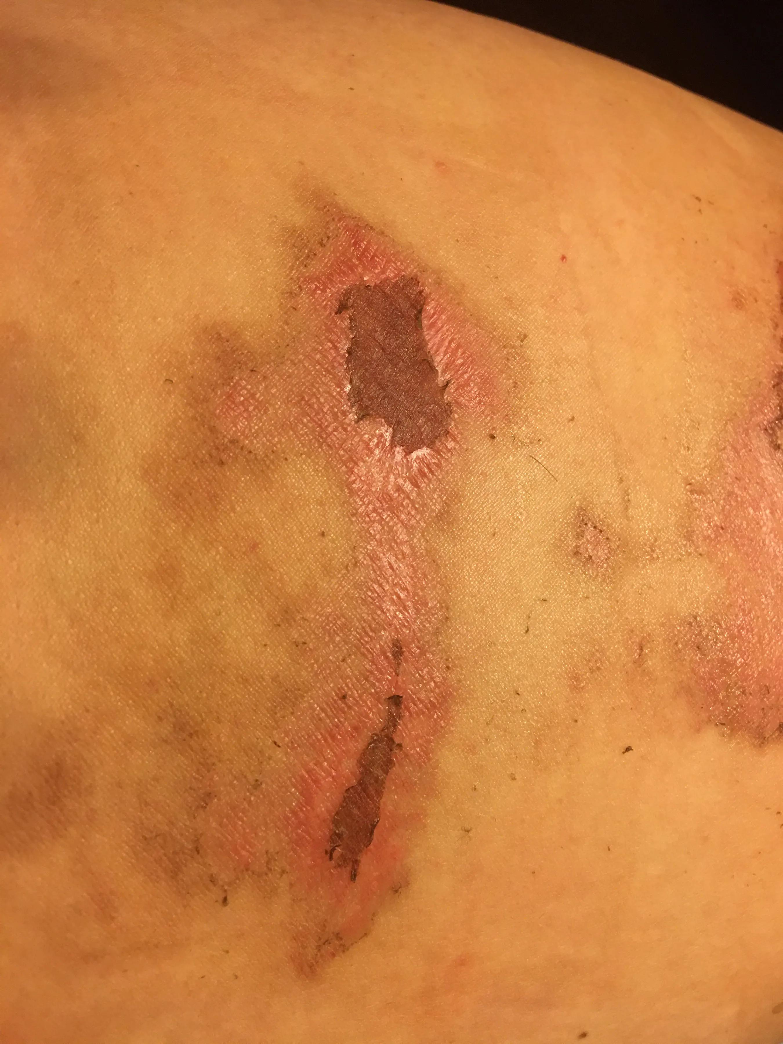 烫伤后续治疗费用怎么赔,烫伤的处理以及案例分析