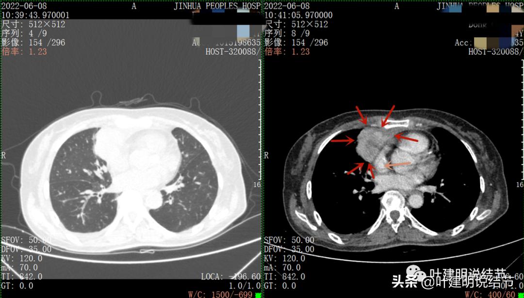 这位老乡，乏力来查，查出这么大个的纵隔肿瘤！会是什么呢？