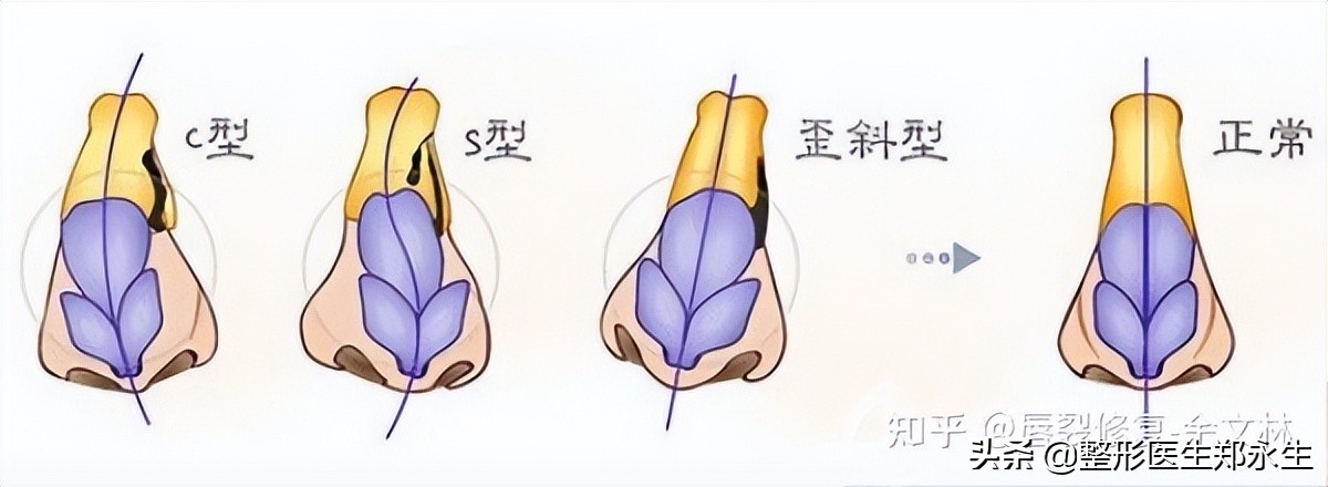 歪鼻原因,歪鼻有哪几种类型又该如何修复