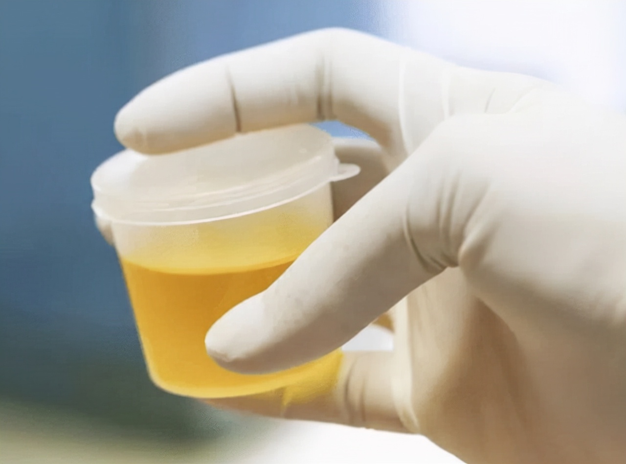 上厕所尿液偏黄是上火了吗,上厕所尿液黄是怎么回事