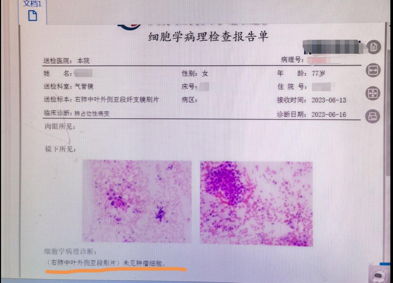 刘懿博士肺癌晚期症状,刘懿肺癌最佳治疗方案