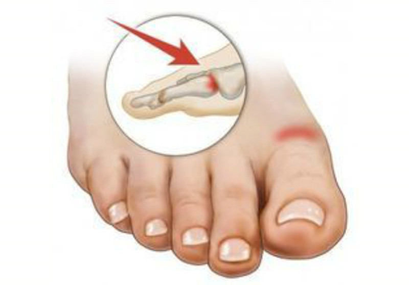 大拇脚趾甲长歪了还能矫正吗,大脚趾甲长歪