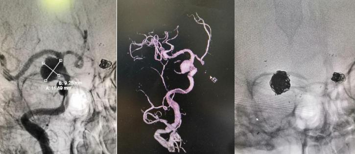 左侧大脑中动脉重度狭窄手术过程,颅内动脉重度狭窄能做手术吗