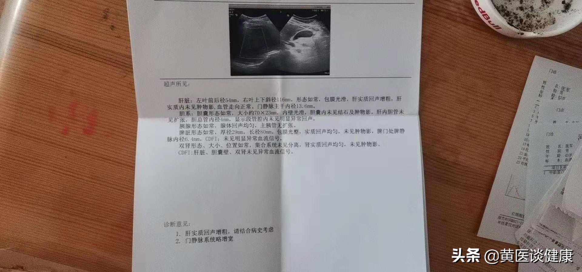 干扰素治疗乙肝降不下去了,干扰素治疗乙肝表面抗体超过10个