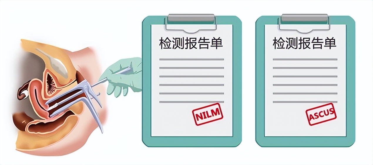 宫颈糜烂肥大囊肿会引起宫颈癌吗,六十岁宫颈糜烂中度会得宫颈癌吗