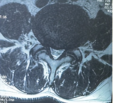 门医技术|门头沟区医院骨二科成功应用微创椎间孔镜技术治疗两例腰椎管多节段狭窄症